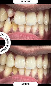 Before and after dental treatment result - unnamed (5).png